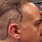 Natural Hairline Design Explained: A Surgeon's Step-by-Step