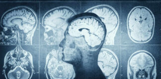 MRI scans of the brain displayed alongside a silhouette of a human head