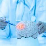 Why Migraines Are More Common in Women Doctor examining a model of a brain with a pen