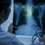 Silent Lung Cancer: Are You at Risk? Doctor examining a chest X-ray with a stethoscope in hand