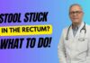 When Constipation Turns Dangerous Impacted Stool Explained: When Poop Gets Stuck in the Rectum