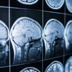 Alzheimer’s Curveball: Sharp Minds, Harder Crash? Close-up of MRI brain scans displayed on a screen