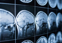 Alzheimer’s Curveball: Sharp Minds, Harder Crash? Close-up of MRI brain scans displayed on a screen