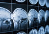 Cancer Mutations In Alzheimer’s Brains? Close-up of MRI brain scans displayed on a screen