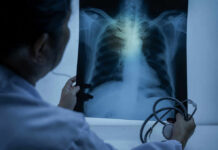 Silent Heart Clues That Flag Cancer Years Early Doctor examining a chest X-ray with a stethoscope in hand