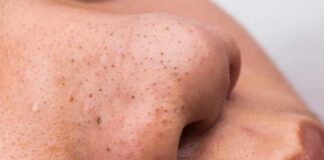 close-up of a nose with visible blackheads