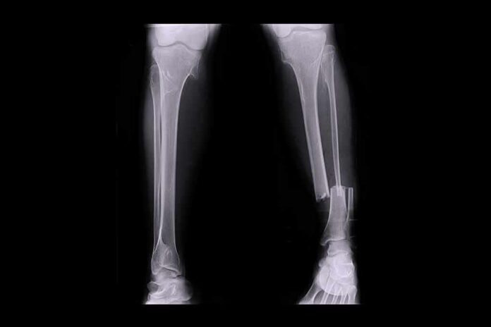 shutterstock_406880140 leg x-ray showing tibia and fibula fracture